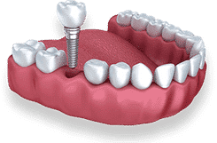 Dental implant model showing screw placement in gum tissue with crown and surrounding teeth.