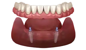 Dental implants demonstration showing prosthetic teeth supported by two implant posts in gum model.