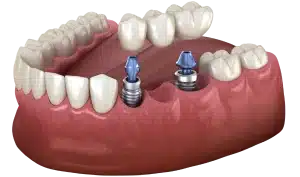 Missing Multiple Teeth